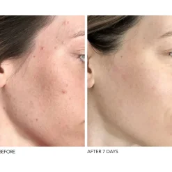 Best DR. DENNIS GROSS Alpha Beta® Universal Daily Peel 30 Pack