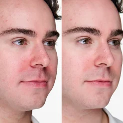 Fashion CLINIQUE Anti-Blemish Solutions Clinical Advanced Clearing Gel