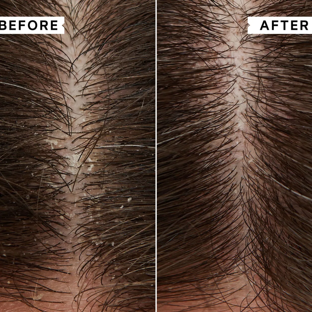 Flaky-Itchy Scalp Anti-Dandruff Shampoo